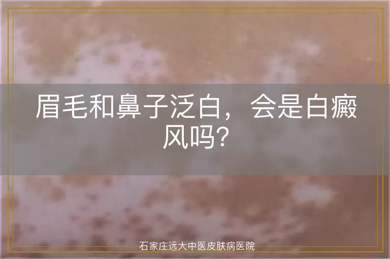 眉毛和鼻子泛白，会是白癜风吗？