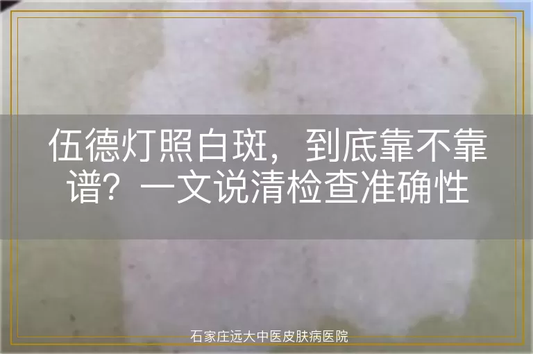 伍德灯照白斑，到底靠不靠谱？一文说清检查准确性