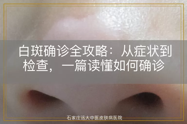 白斑确诊全攻略：从症状到检查，一篇读懂如何确诊