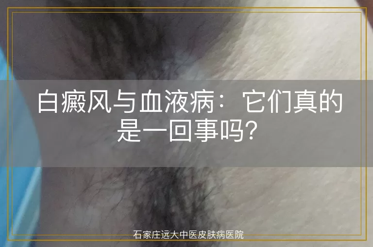 白癜风与血液病：它们真的是一回事吗？