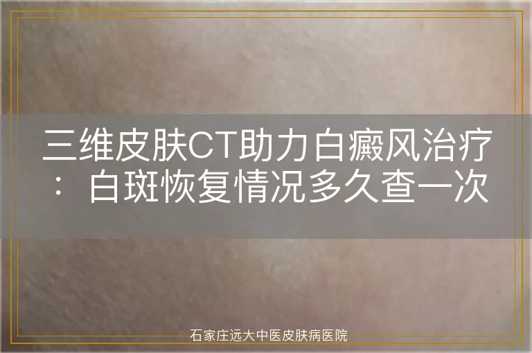 三维皮肤CT助力白癜风治疗：白斑恢复情况多久查一次最合适？