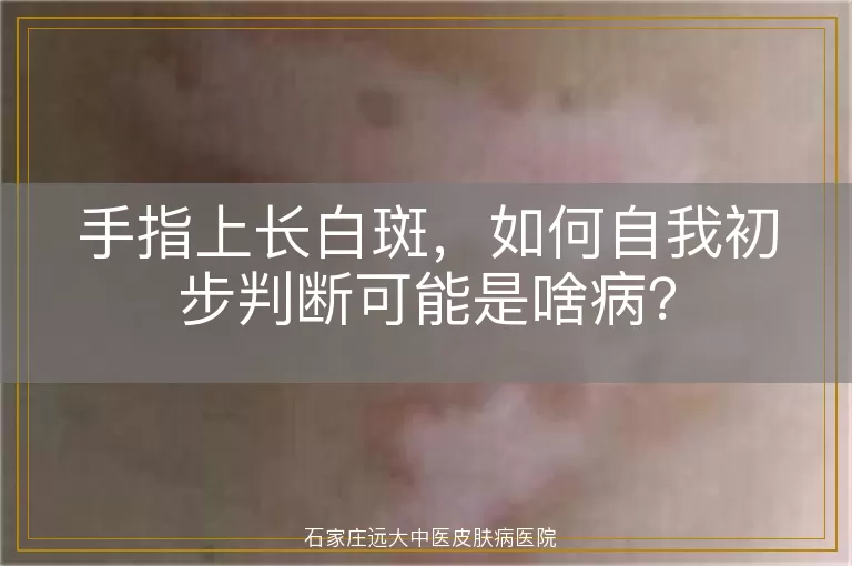 手指上长白斑，如何自我初步判断可能是啥病？