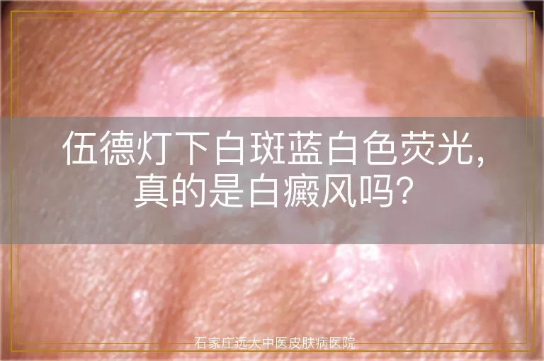 伍德灯下白斑蓝白色荧光，真的是白癜风吗？