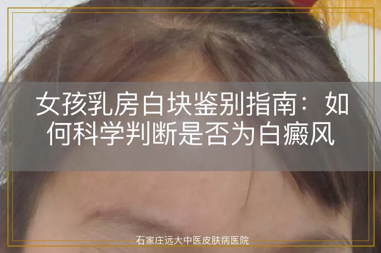 女孩乳房白块鉴别指南：如何科学判断是否为白癜风