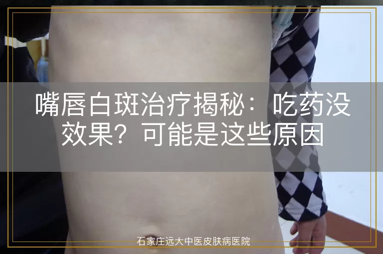 嘴唇白斑治疗揭秘:吃药没效果?可能是这些原因