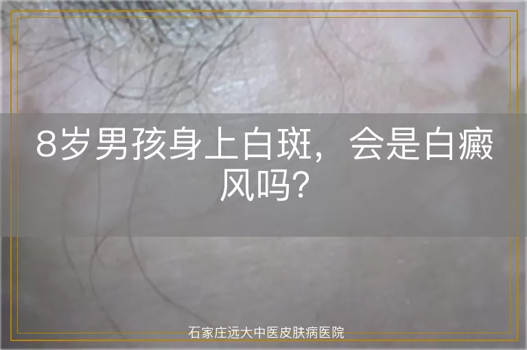 8岁男孩身上白斑，会是白癜风吗？