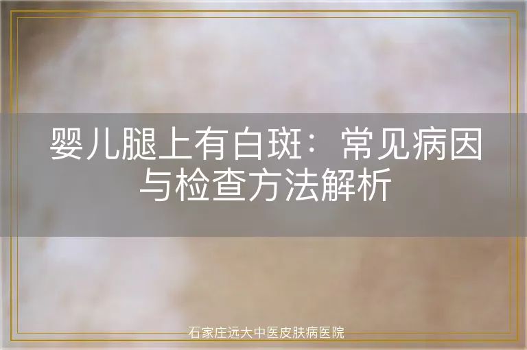 婴儿腿上有白斑：常见病因与检查方法解析