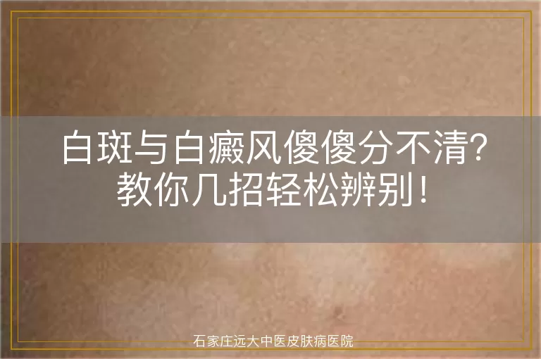 白斑与白癜风傻傻分不清？教你几招轻松辨别！