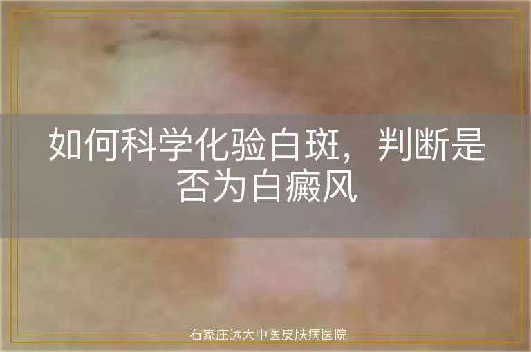 如何科学化验白斑，判断是否为白癜风