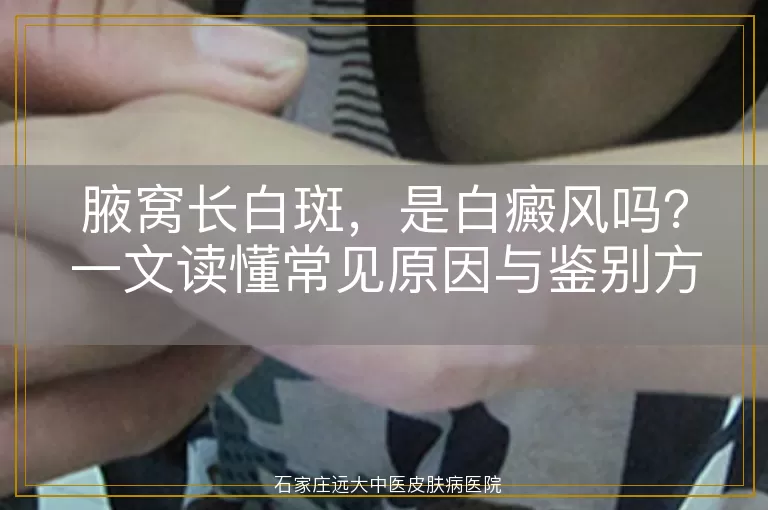 腋窝长白斑,是白癜风吗?一文读懂常见原因与鉴别方法