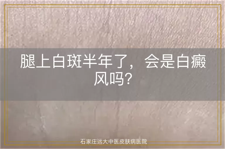 腿上白斑半年了，会是白癜风吗？