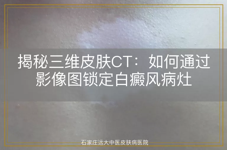揭秘三维皮肤CT：如何通过影像图锁定白癜风病灶