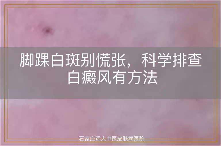 脚踝白斑别慌张,科学排查白癜风有方法