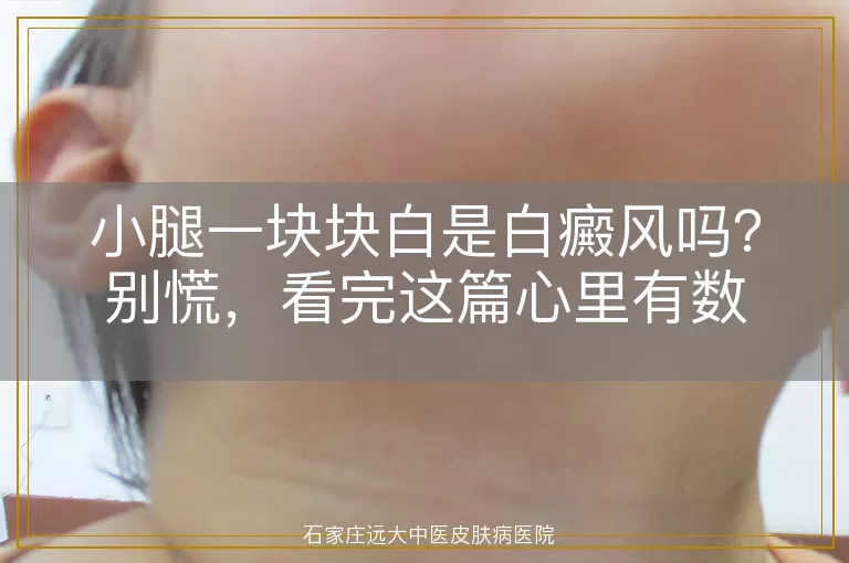 小腿一块块白是白癜风吗？别慌，看完这篇心里有数