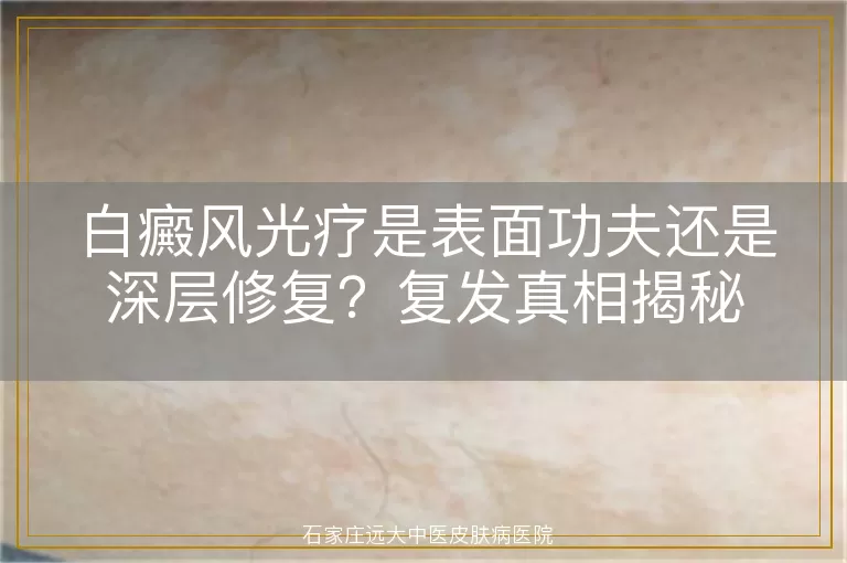 白癜风光疗是表面功夫还是深层修复？复发真相揭秘