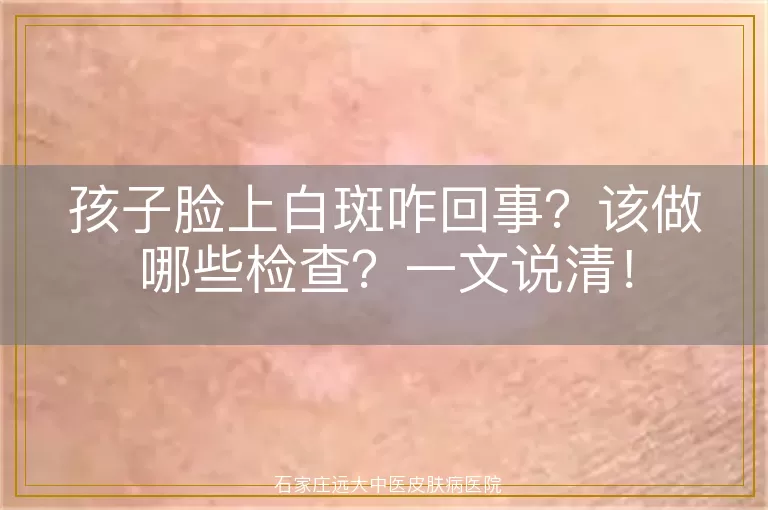 孩子脸上白斑咋回事？该做哪些检查？一文说清！