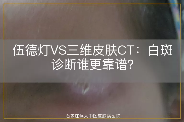 伍德灯VS三维皮肤CT：白斑诊断谁更靠谱？