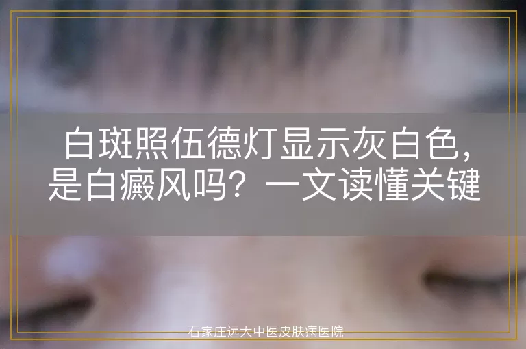 白斑照伍德灯显示灰白色，是白癜风吗？一文读懂关键细节