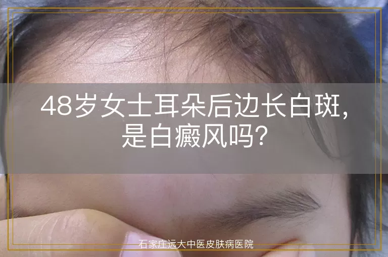 48岁女士耳朵后边长白斑，是白癜风吗？
