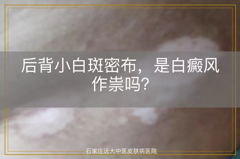 后背小白斑密布，是白癜风作祟吗？