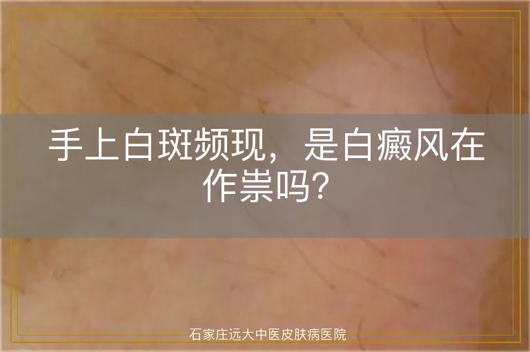 手上白斑频现，是白癜风在作祟吗？