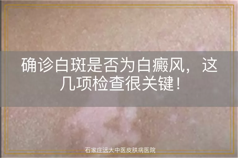 确诊白斑是否为白癜风，这几项检查很关键！