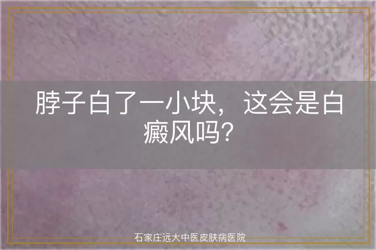 脖子白了一小块，这会是白癜风吗？