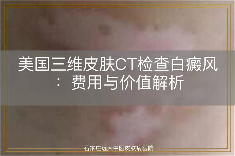 美国三维皮肤CT检查白癜风：费用与价值解析