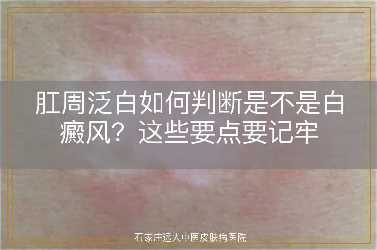 肛周泛白如何判断是不是白癜风？这些要点要记牢
