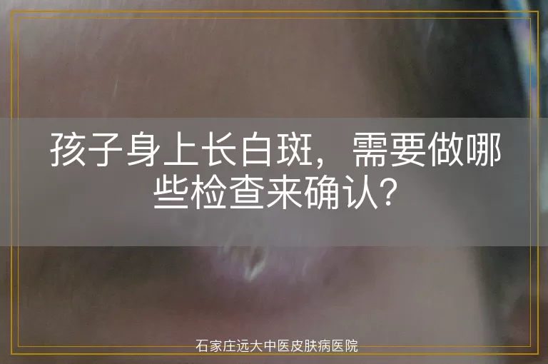孩子身上长白斑，需要做哪些检查来确认？
