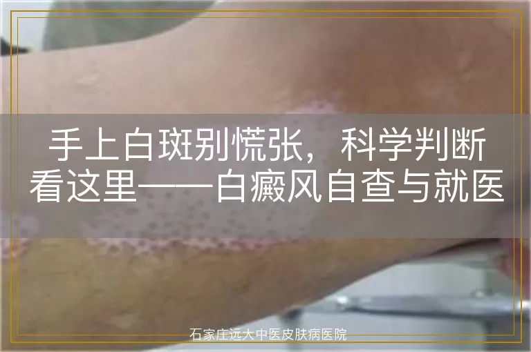 手上白斑别慌张，科学判断看这里——白癜风自查与就医指南