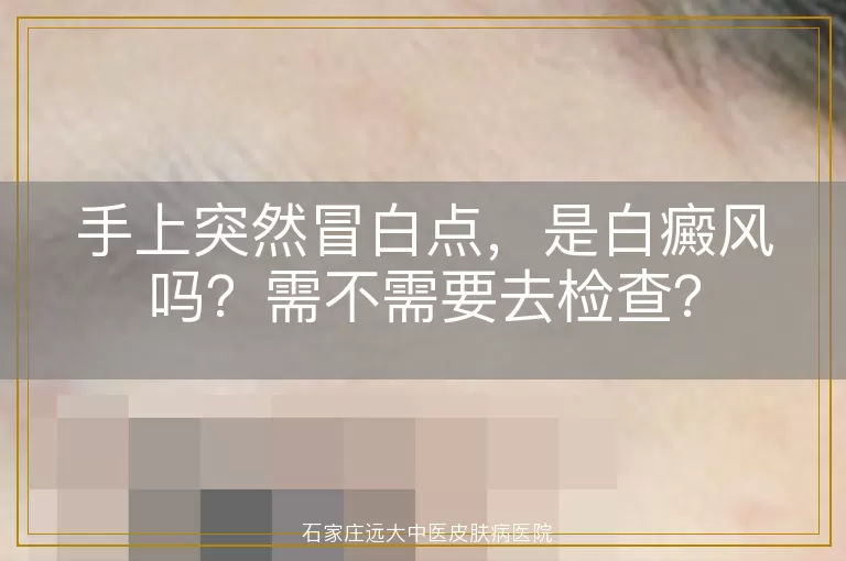 手上突然冒白点，是白癜风吗？需不需要去检查？