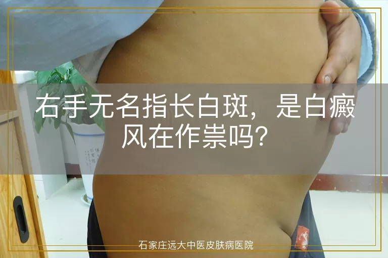 右手无名指长白斑，是白癜风在作祟吗？