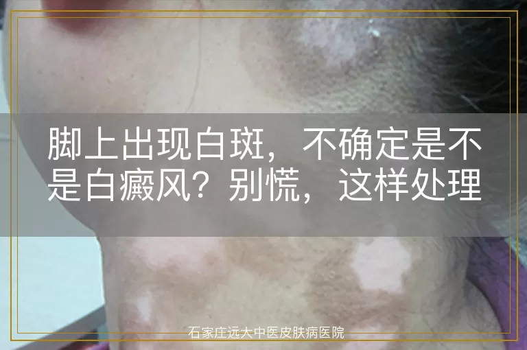 脚上出现白斑，不确定是不是白癜风？别慌，这样处理更靠谱！