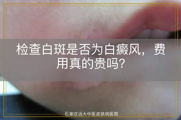 检查白斑是否为白癜风，费用真的贵吗？