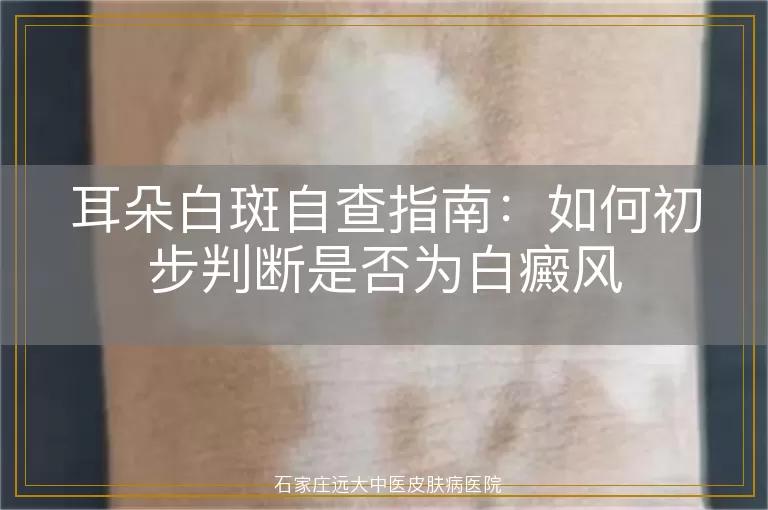 耳朵白斑自查指南：如何初步判断是否为白癜风