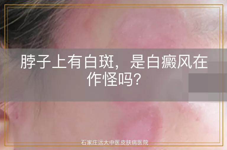 脖子上有白斑，是白癜风在作怪吗？