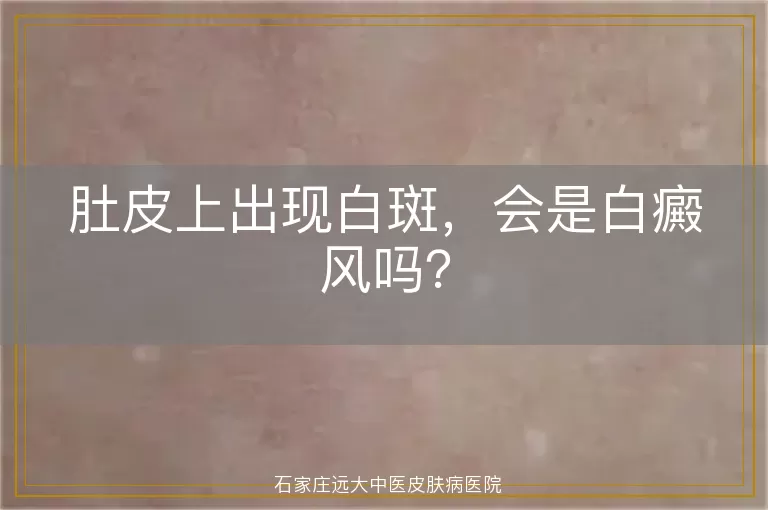 肚皮上出现白斑，会是白癜风吗？