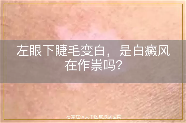 左眼下睫毛变白，是白癜风在作祟吗？