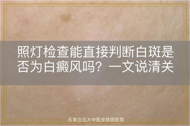照灯检查能直接判断白斑是否为白癜风吗？一文说清关键点