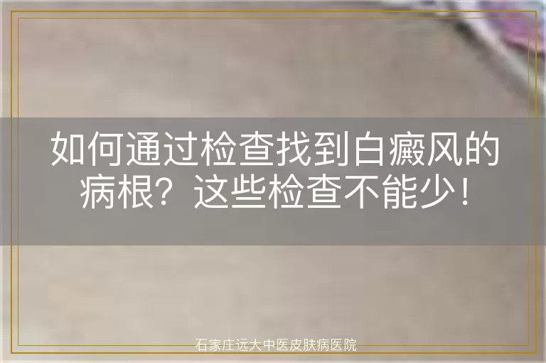 如何通过检查找到白癜风的病根？这些检查不能少！
