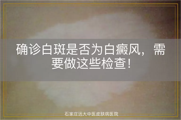 确诊白斑是否为白癜风，需要做这些检查！