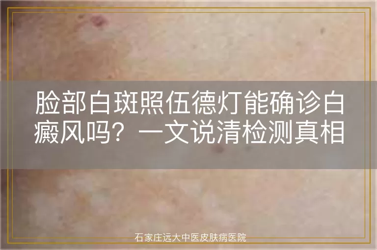 脸部白斑照伍德灯能确诊白癜风吗？一文说清检测真相