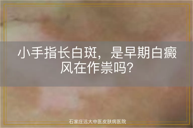 小手指长白斑，是早期白癜风在作祟吗？