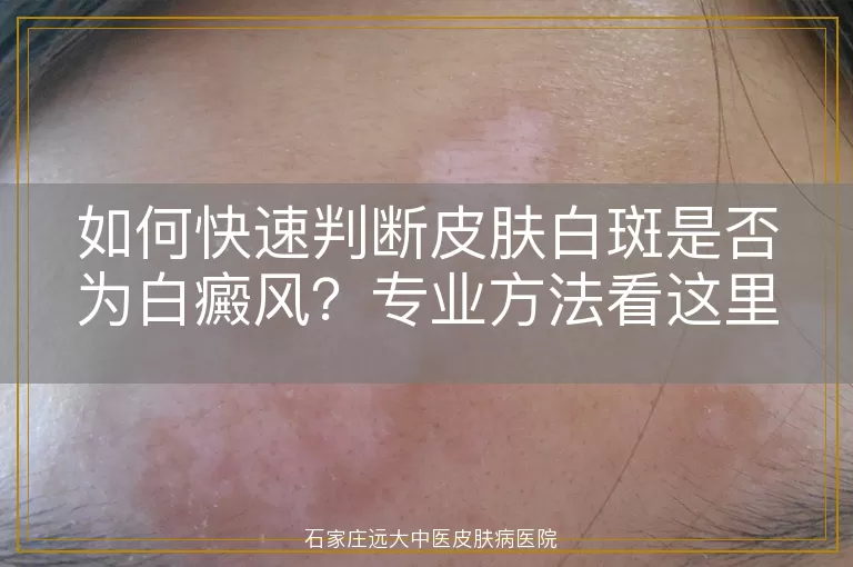 如何快速判断皮肤白斑是否为白癜风？专业方法看这里！