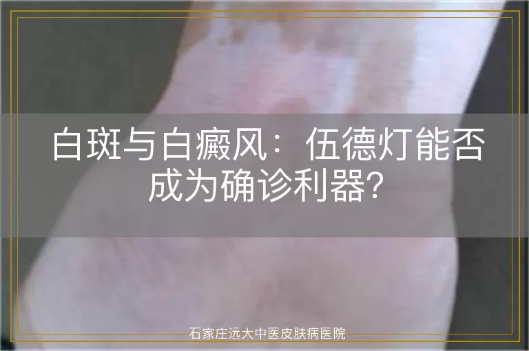 白斑与白癜风：伍德灯能否成为确诊利器？