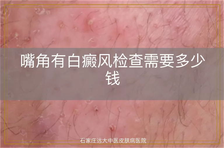 嘴角有白癜风检查需要多少钱