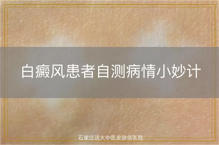 白癜风患者自测病情小妙计