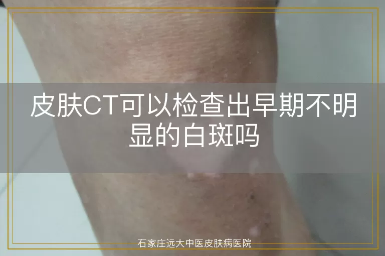 皮肤CT可以检查出早期不明显的白斑吗