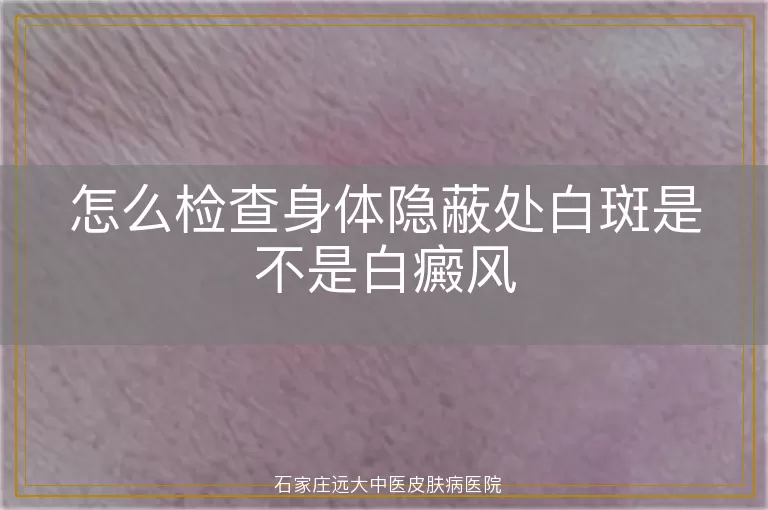 怎么检查身体隐蔽处白斑是不是白癜风